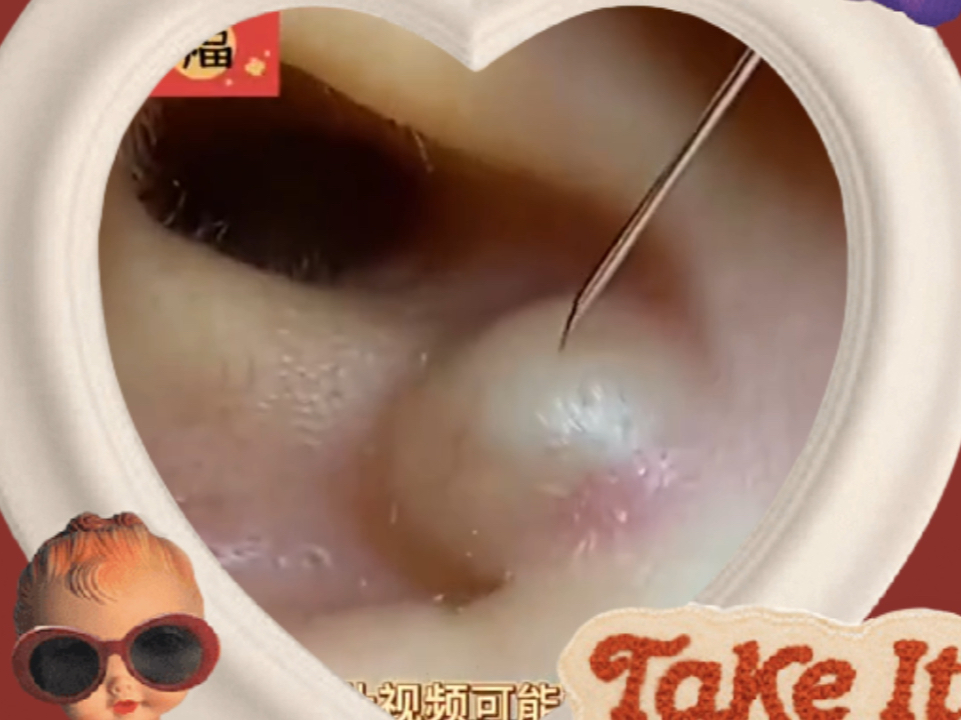耳朵里长了好大一个脓包,里面好多花生酱