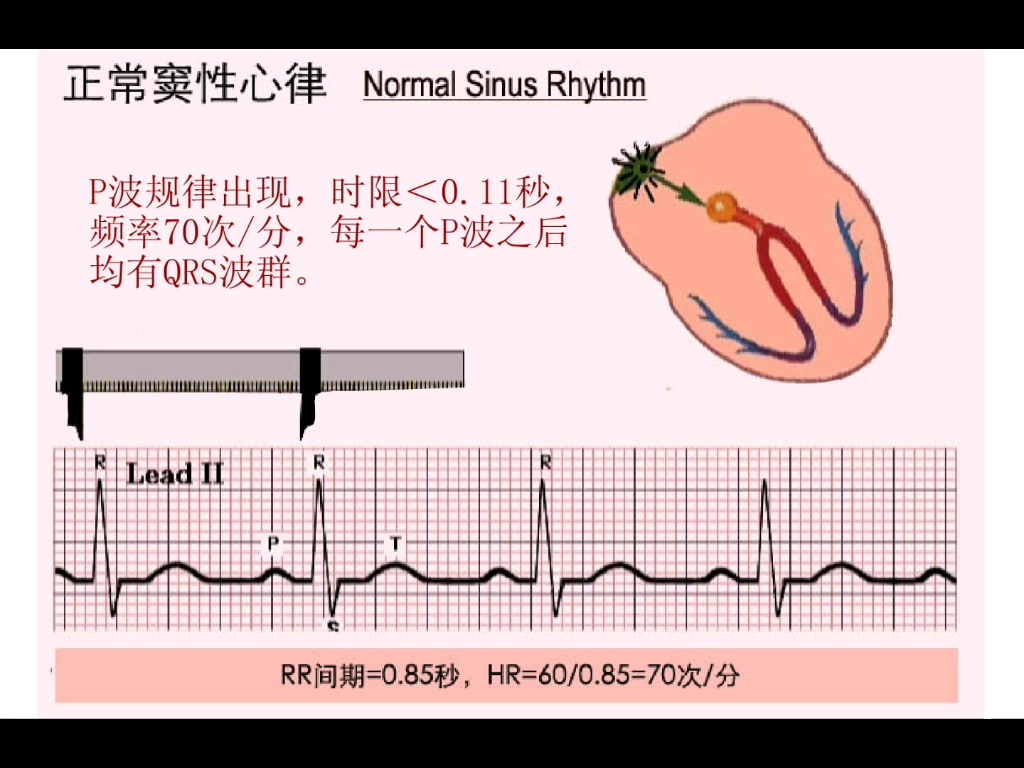 正常窦性心律哔哩哔哩bilibili