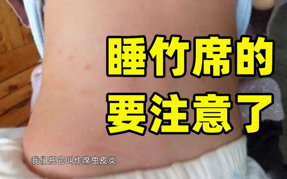 [图]【阿六头说新闻】痒到睡不着！这种皮肤病跟席子有关