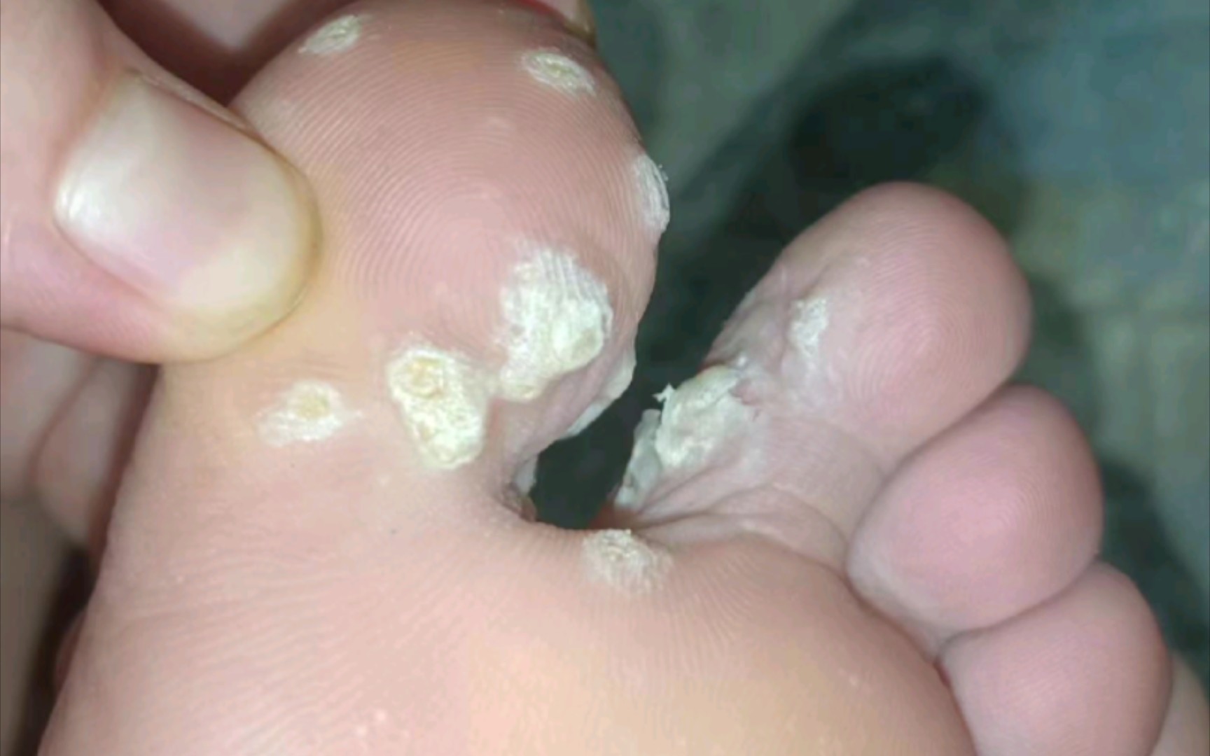 激光后 扩散 群发性跖疣涂抹脱落全过程.