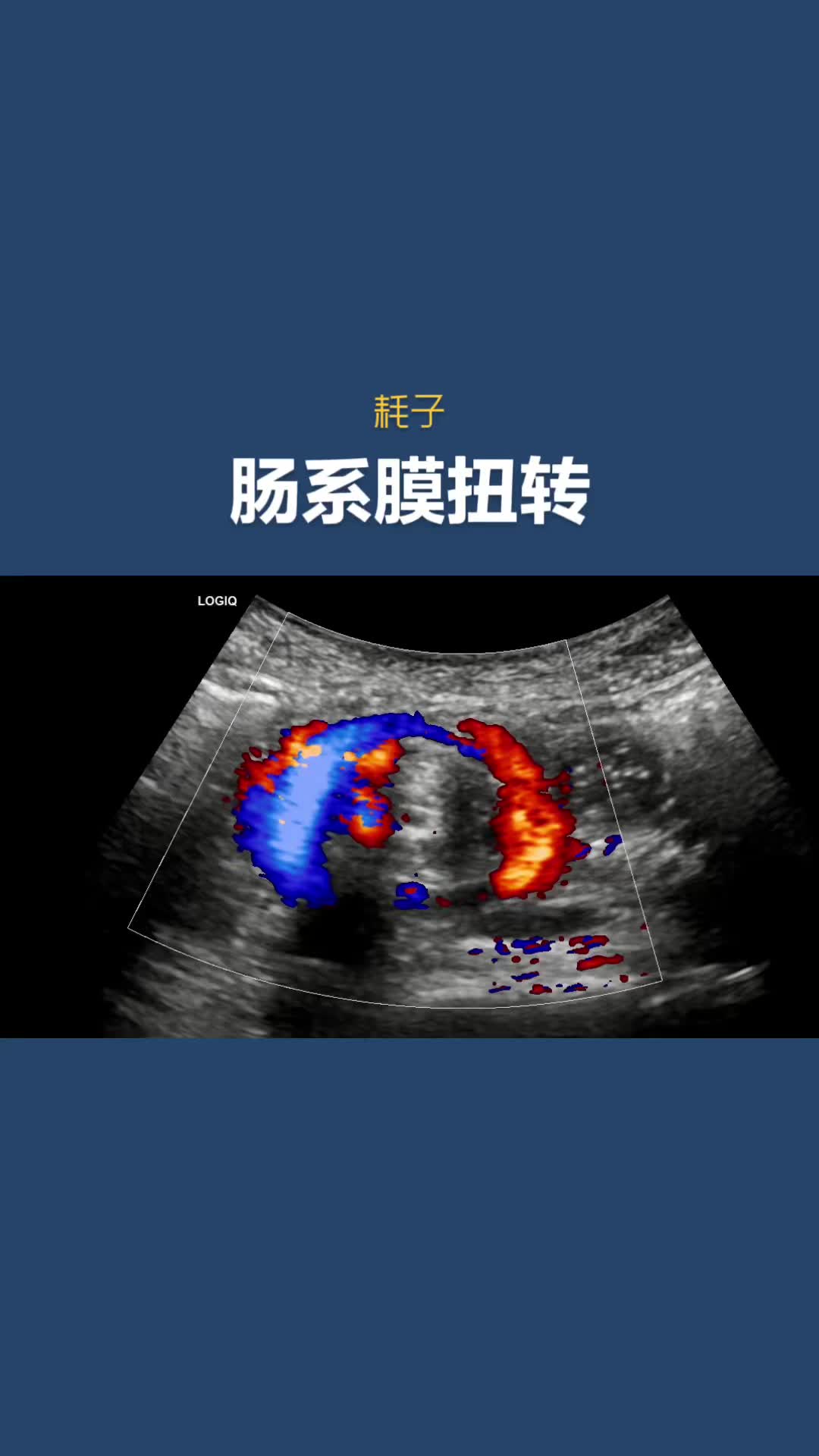 肠系膜扭转超声影像哔哩哔哩bilibili