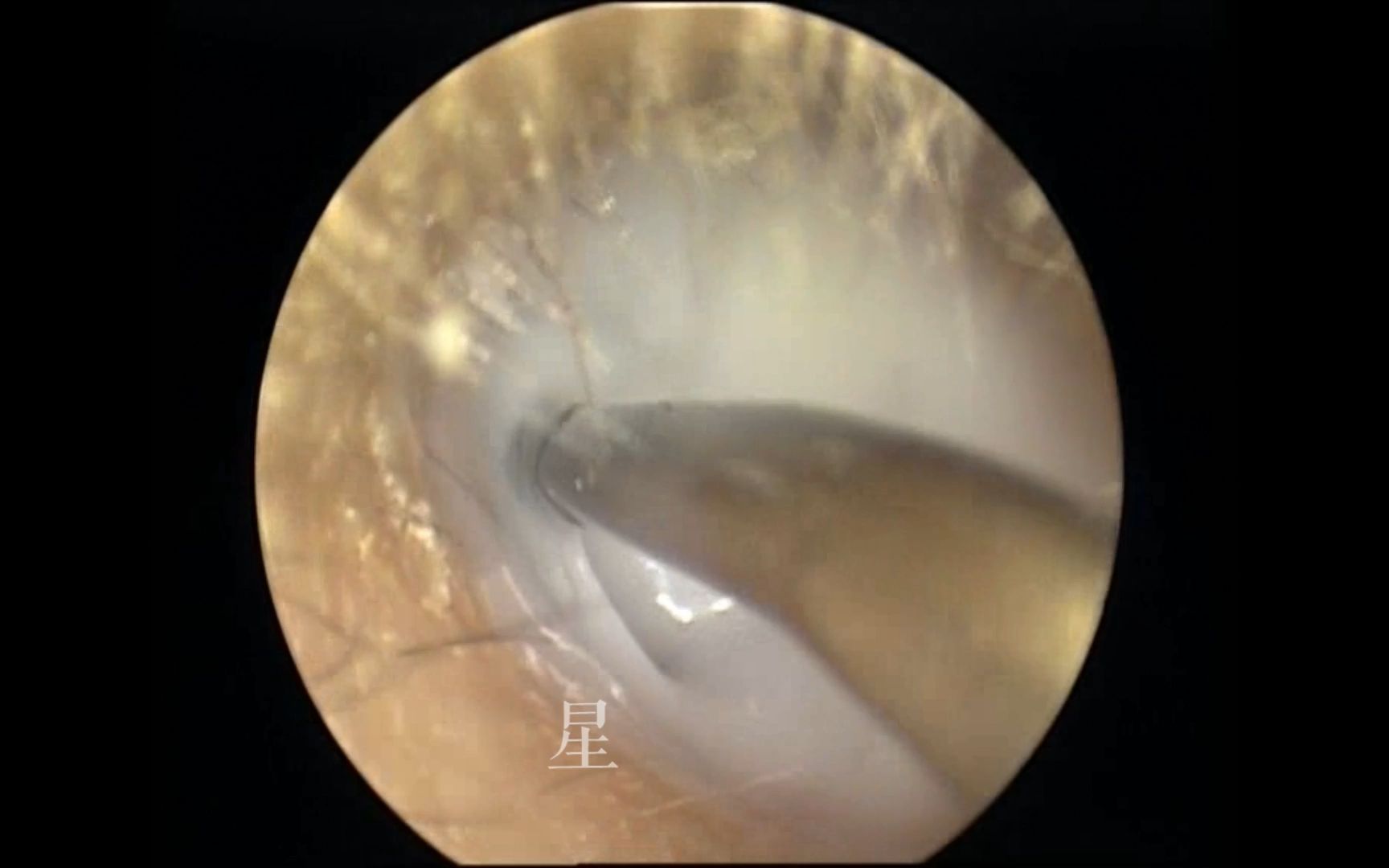 【星医生】外耳道真菌感染治疗哔哩哔哩bilibili