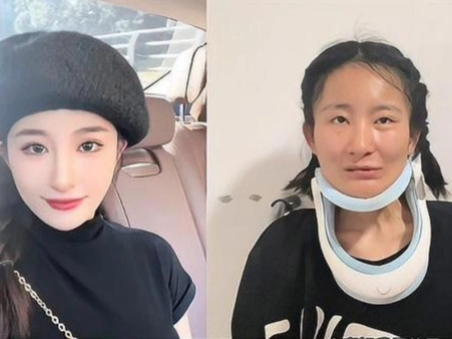 女生确诊渐冻症一年容貌巨变