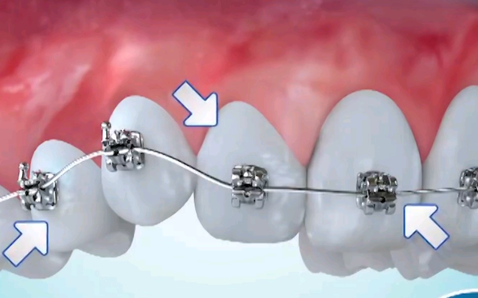 牙齿是怎么矫正的牙槽骨在托槽外力的作用下可以重新改建使牙齿移动到