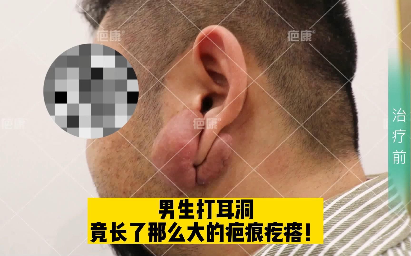 男生打耳洞竟长了那么大的疤痕疙瘩!