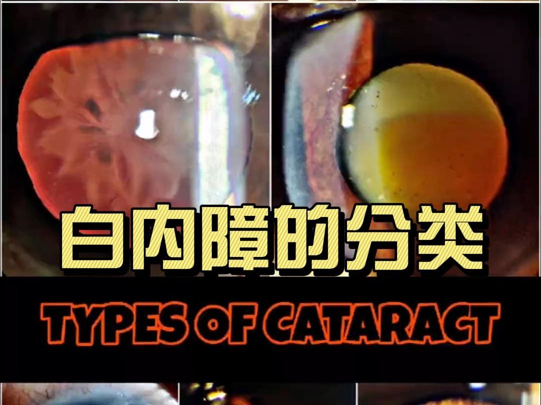 【图鉴】【白内障分类】【Types Of Cataract】Classification of Cataract哔哩哔哩bilibili