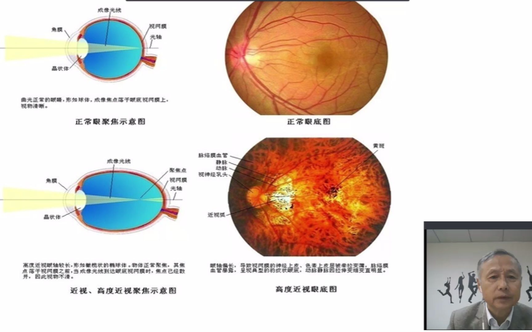 [图]家长课堂：高度近视眼的危害