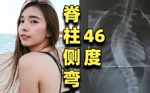 Download Video: 脊柱侧弯最全分享：13岁的噩梦，如今挺直腰背做人！