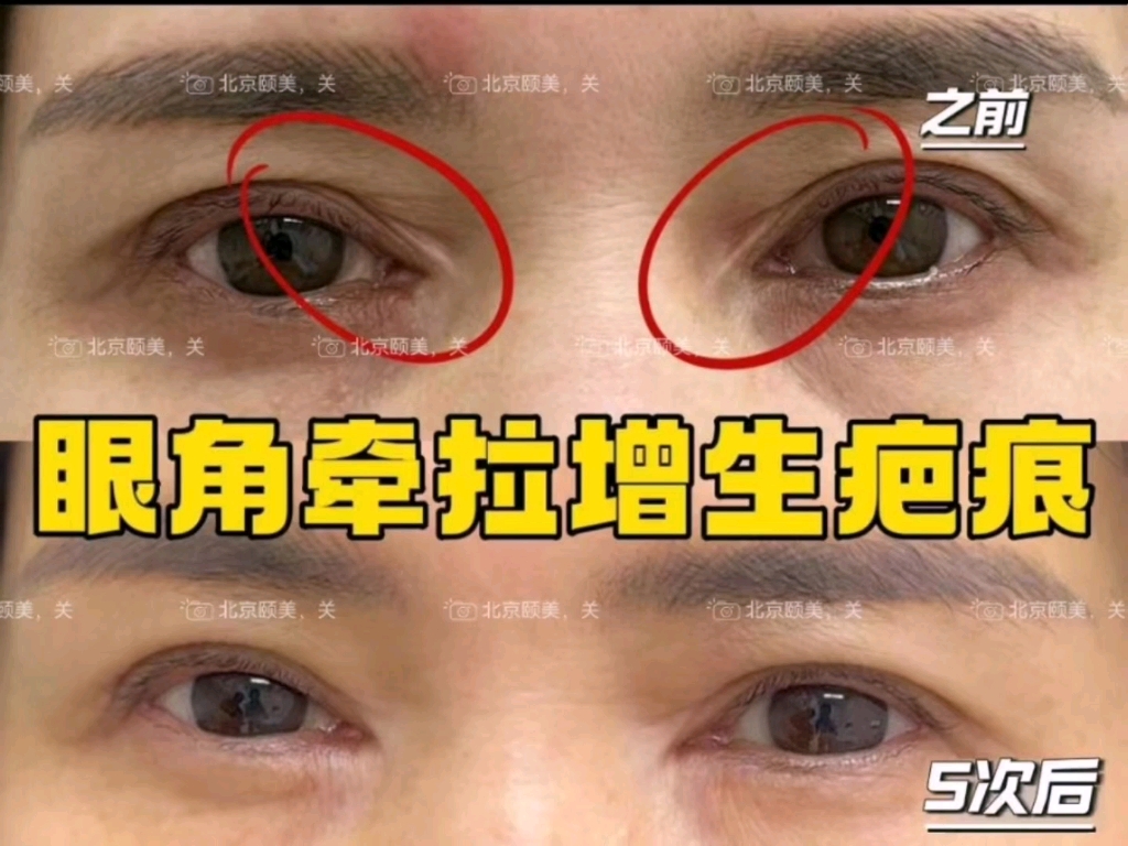 开眼角后留下的增生疤痕,眼角处明显的有牵拉感,这是治疗过程中的对比