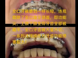 Download Video: 汕头市林梅城口腔科诊所多名“白衣天使”非法行医把患者当实验品，矫正六年失败的惊悚案例！！！