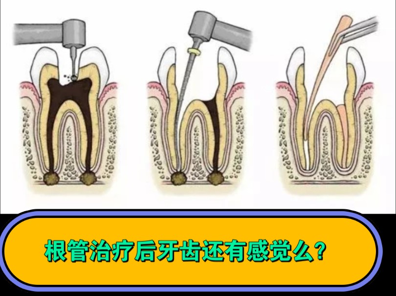 根管治疗后牙齿还有感觉么?答案是:有的!哔哩哔哩bilibili