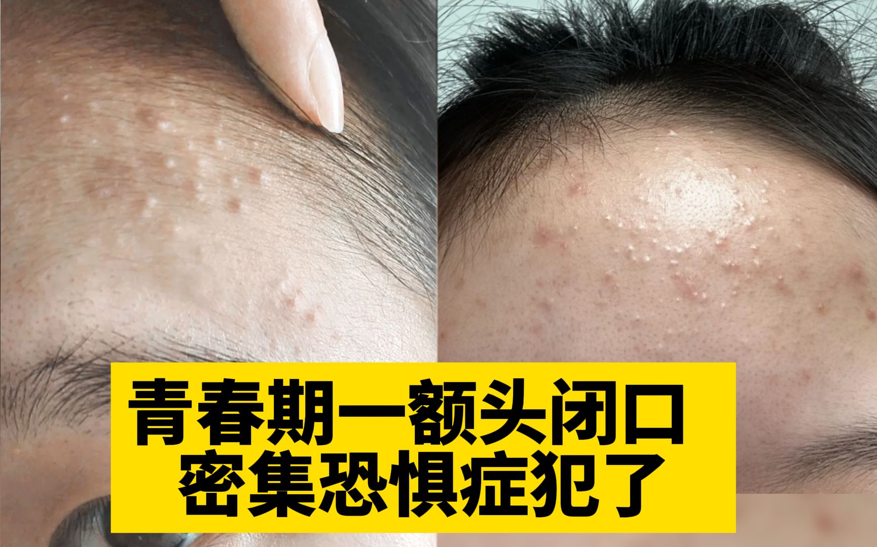 [图]【科普】困扰孩子整个青春期的闭口粉刺，非常影响颜值和心理健康！