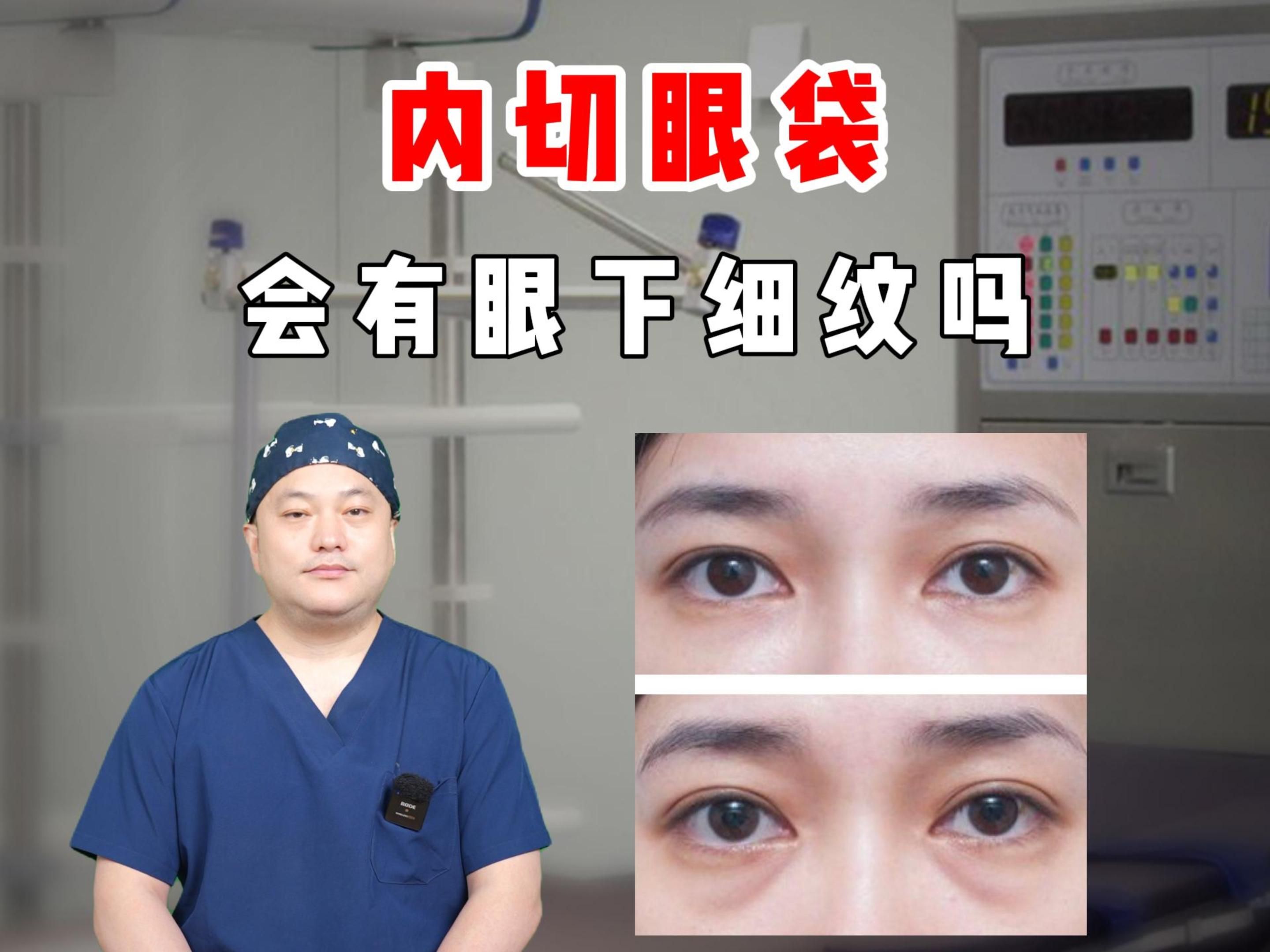 内切眼袋,会有眼下细纹吗 ?