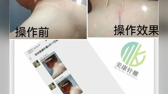 美康针灸美雕效果就是好