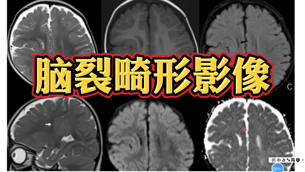 脑裂畸形在MRI图像上什么表现?放射科医生讲解!哔哩哔哩bilibili