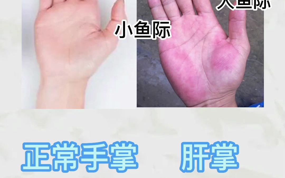 正常手掌和肝掌的不同哔哩哔哩bilibili