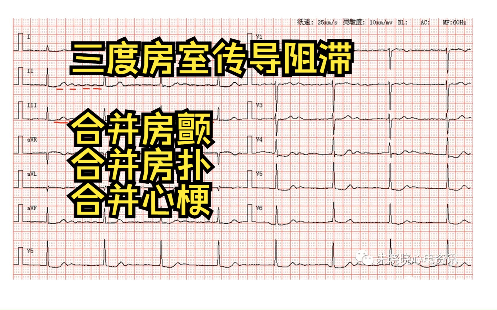 [图]【心电图学习5】| 三度房室阻滞合并心梗，合并房颤，合并房扑