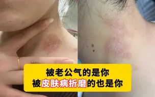 Download Video: 【科普】被老公气的是你，被神经性皮炎折磨的也是你，你说何必呢？生活还是得开心快乐放在第一位！