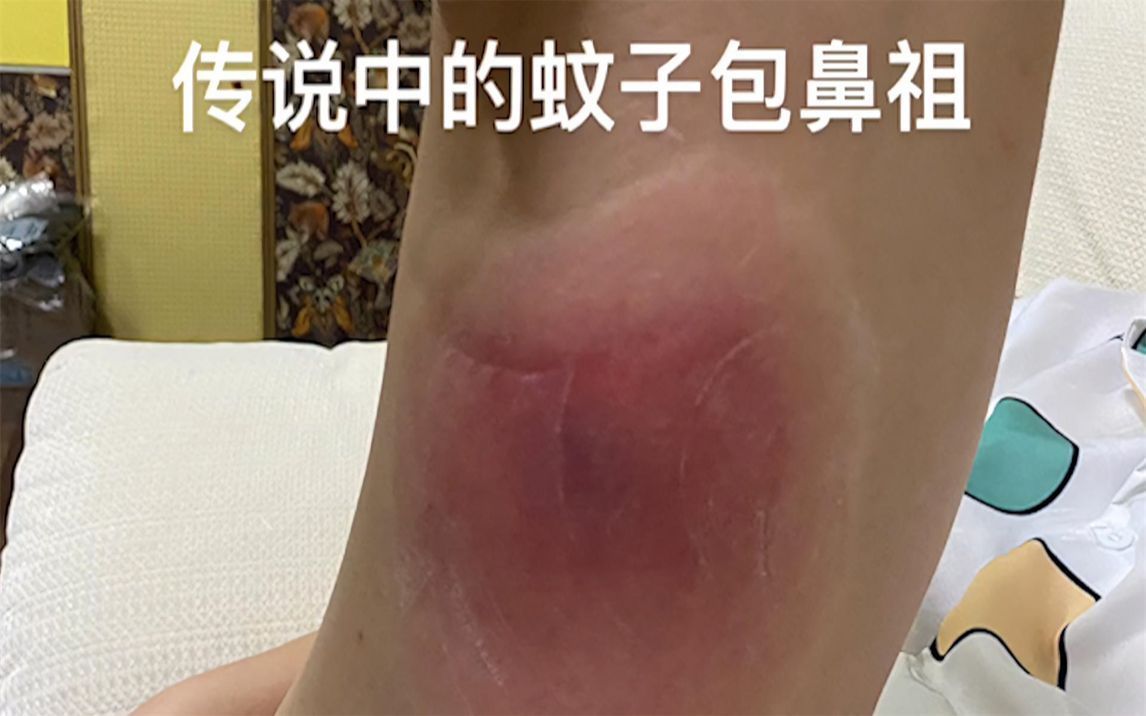 女子被蚊子咬了个碗口大的包:花了千元治疗,觉得挺离谱的