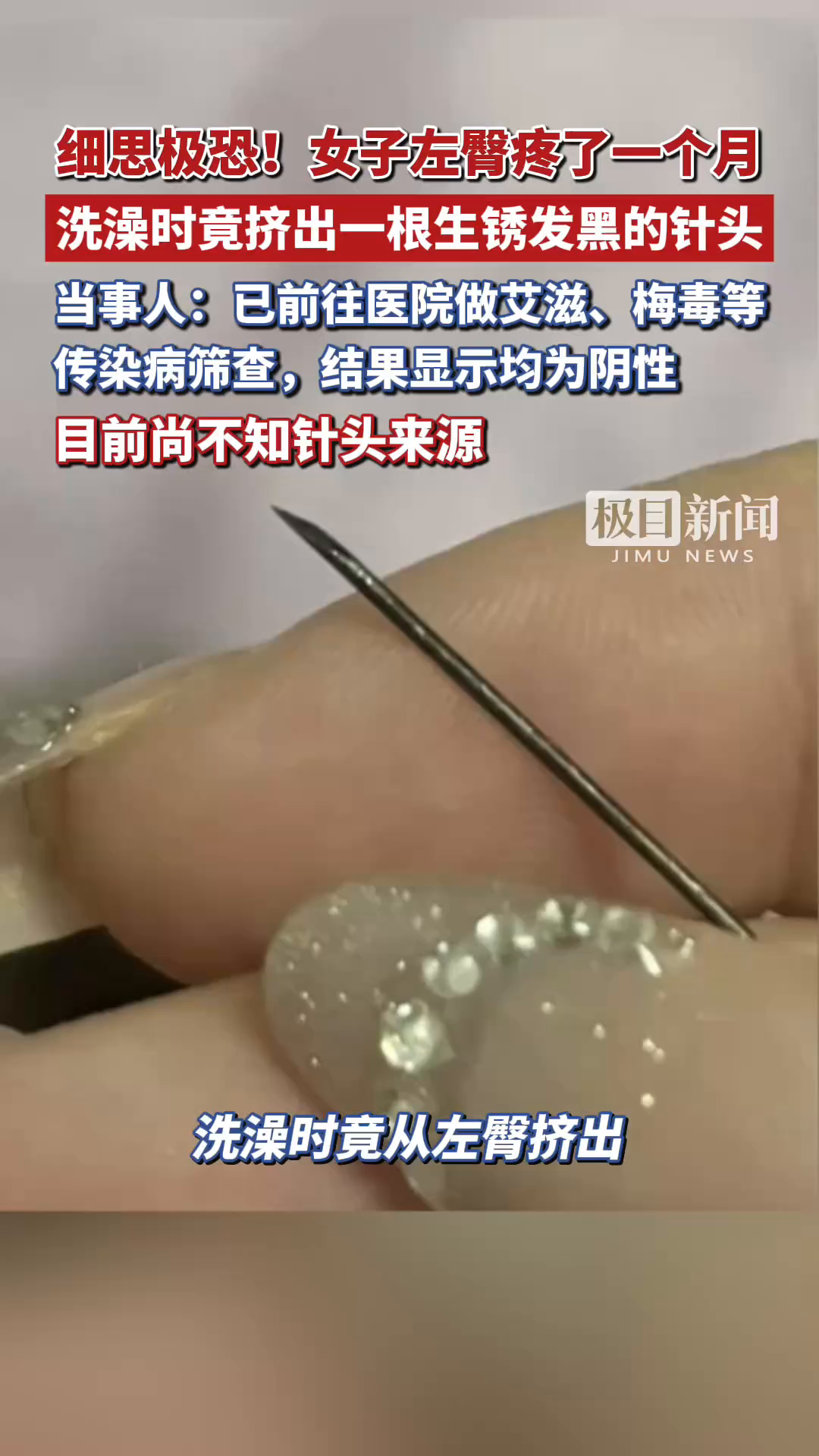 细思极恐！浙江一女子洗澡时，左臀竟挤出一根生锈发黑的针头，当事人：已前往医院做艾滋、梅毒等传染病筛查，结果显示均为阴性