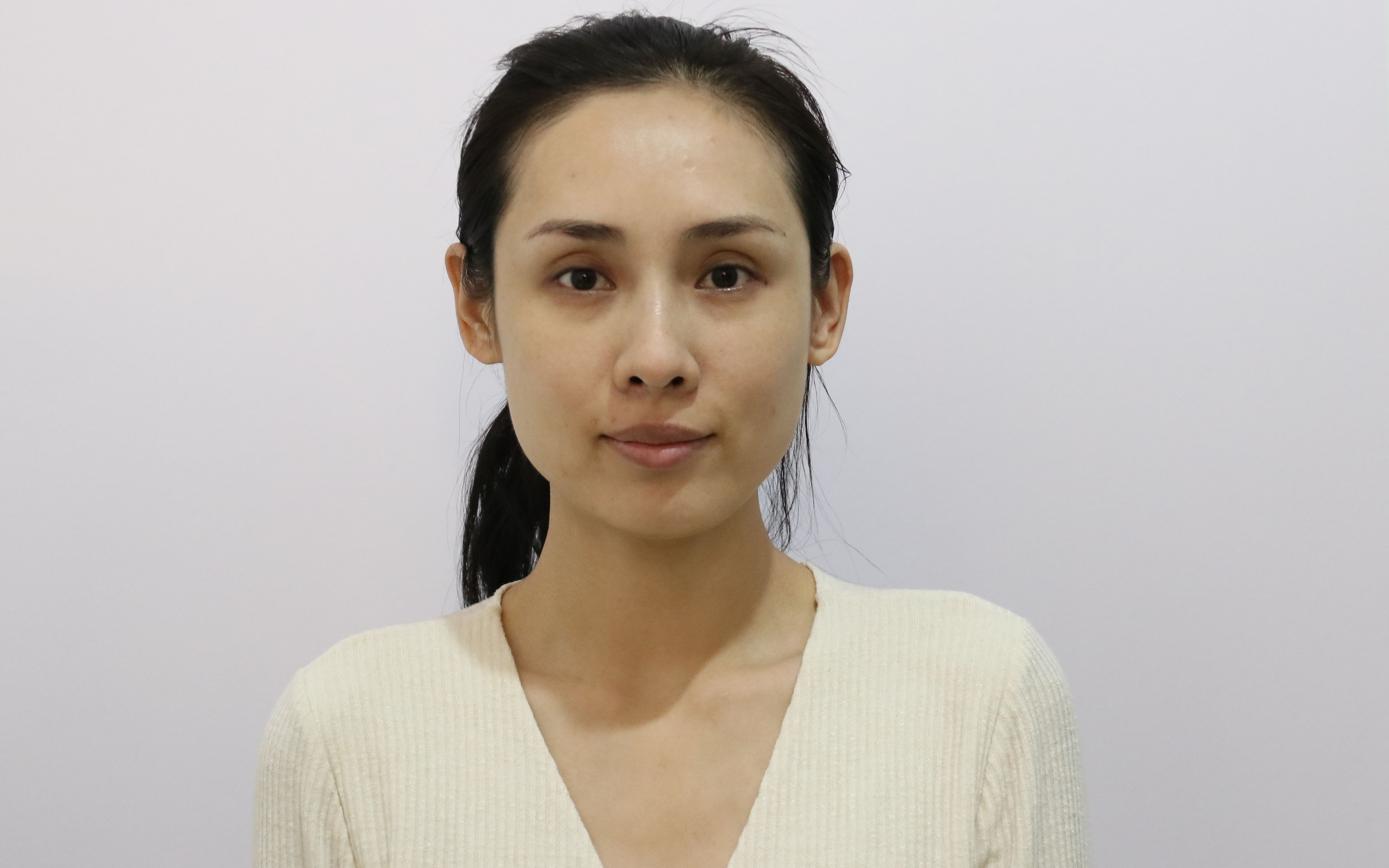 脸部松垮,我的模特生涯都快不行了,还好朋友推荐了埋线