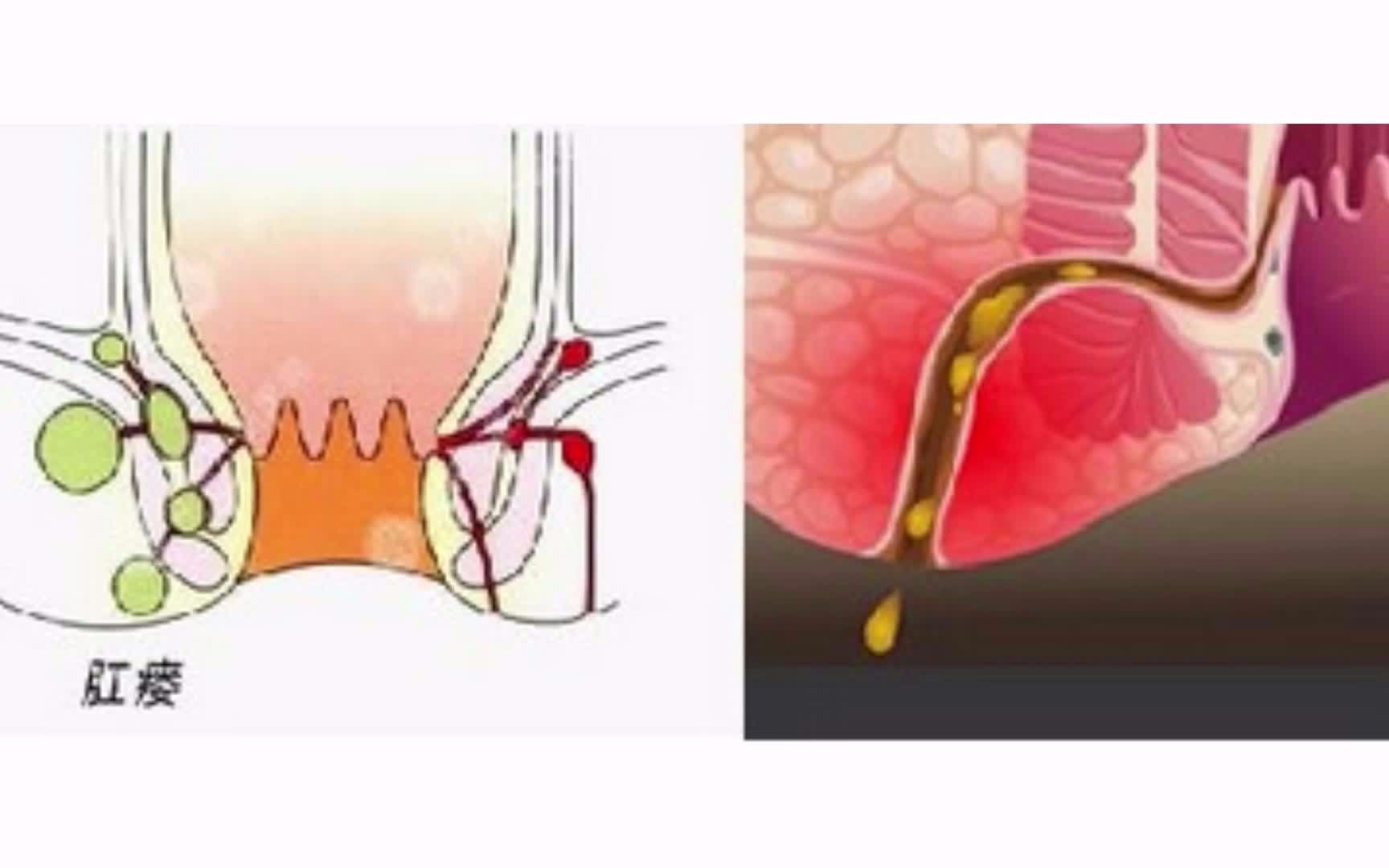 肛瘘的形成哔哩哔哩bilibili