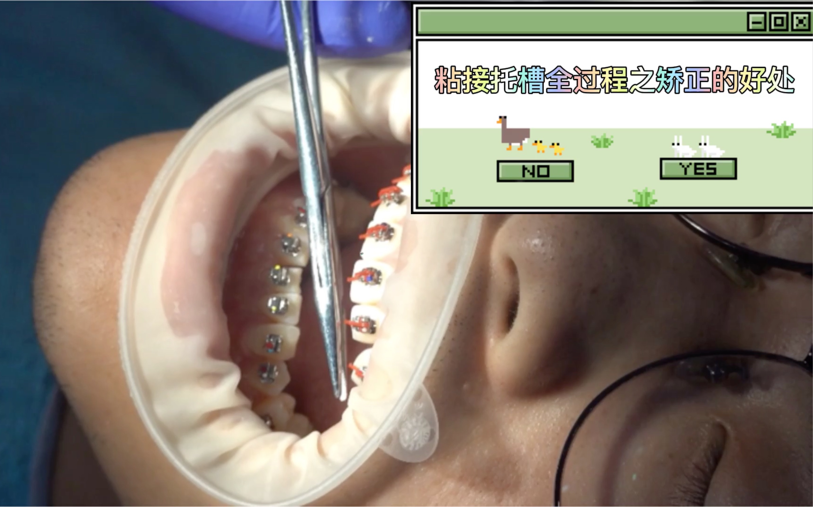 牙齿矫正之托槽粘接