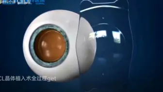 亲身经历icl晶体植入近视手术分享篇 姐妹们 我终于看清世界了 这个手术竟然很多人都不知道 先带你了解一下 哔哩哔哩 Bilibili