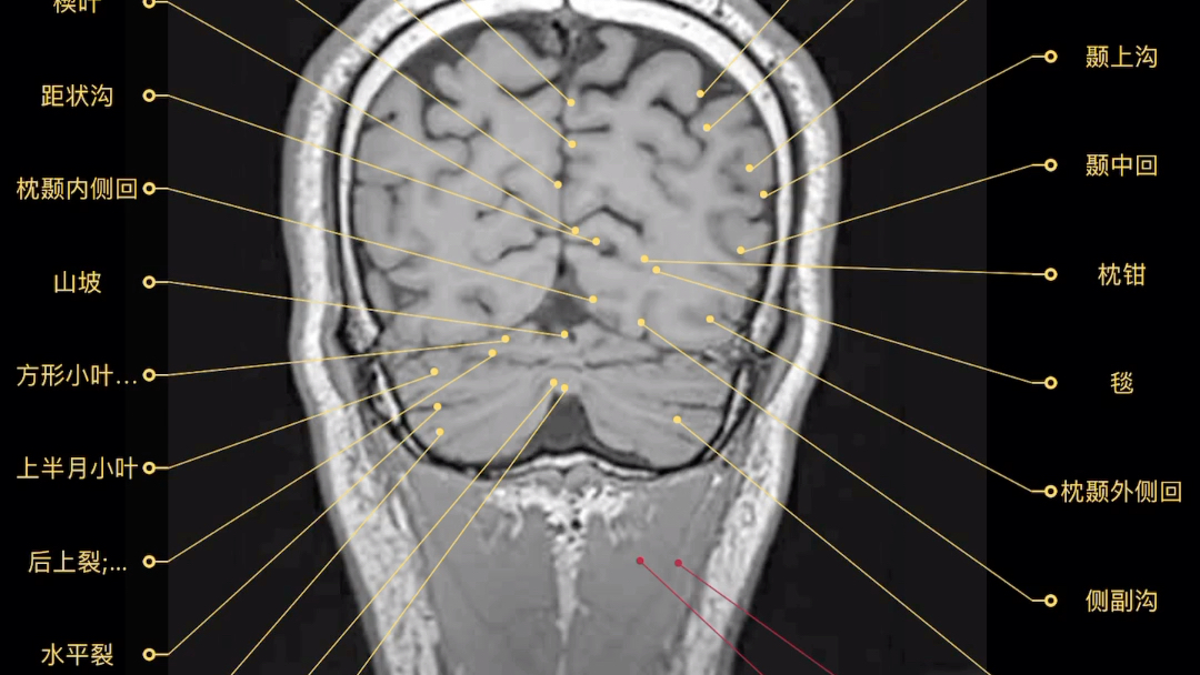 [图]第二弹干货！颅脑（冠状位）磁共振详细断层图像！