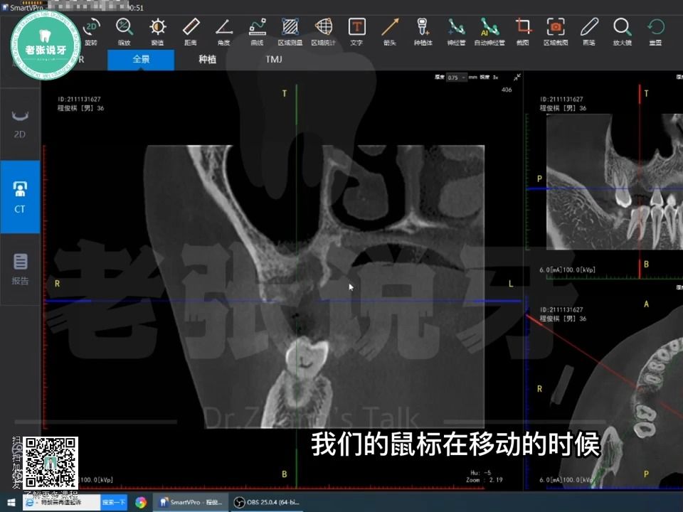 口腔CT阅片技巧与临床运用(二)哔哩哔哩bilibili