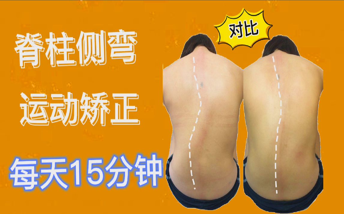 脊柱后凸矫正器_脊柱后凸矫正手术后遗症_脊柱后凸自我矫正法