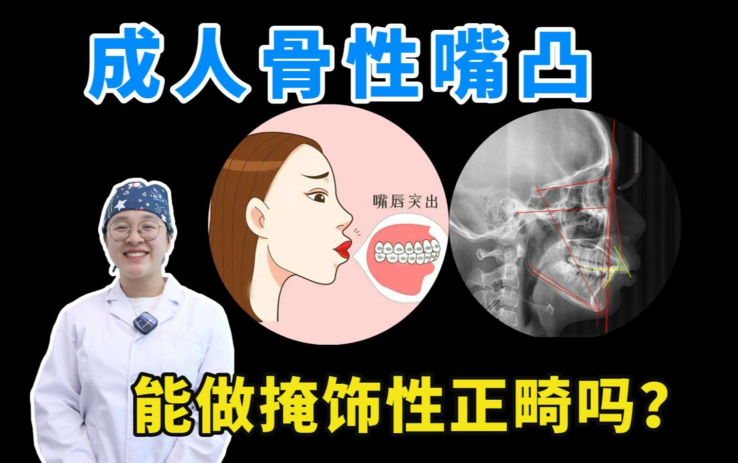 [图]成人骨性嘴凸，可以做掩饰性正畸吗？