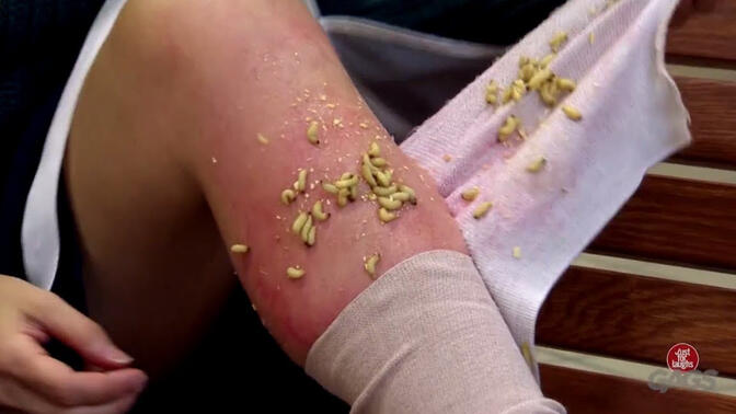 高能慎入:满腿爬虫子