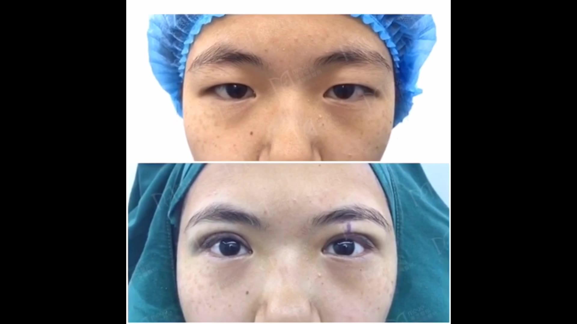 又是今年的高考生 姑娘肉眼泡明显,眼睛无神,喜欢自然的双眼皮