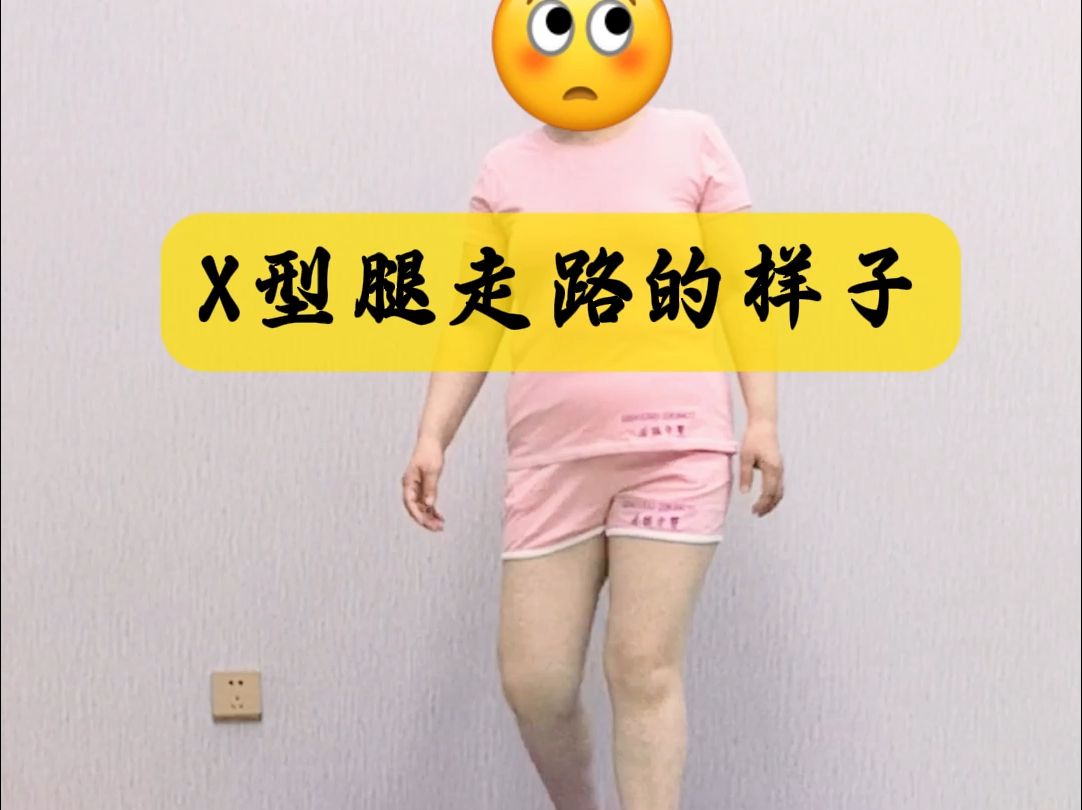 x型腿走路,究竟是怎样一种画风?