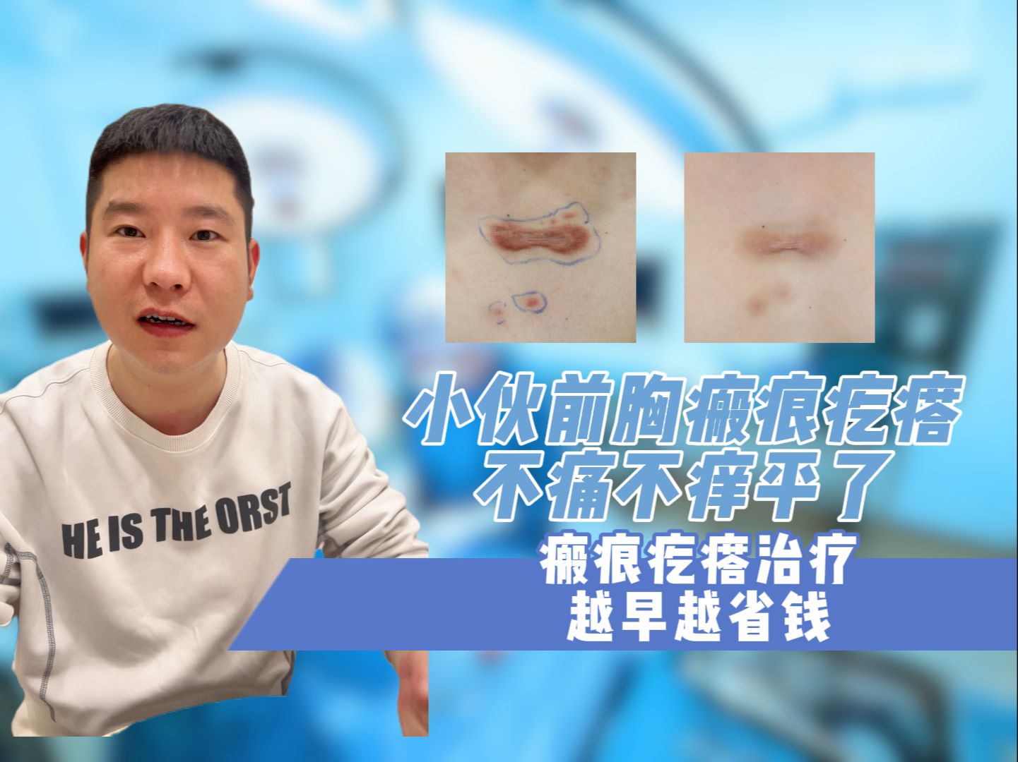 小伙前胸瘢痕疙瘩,不痛不痒平了
