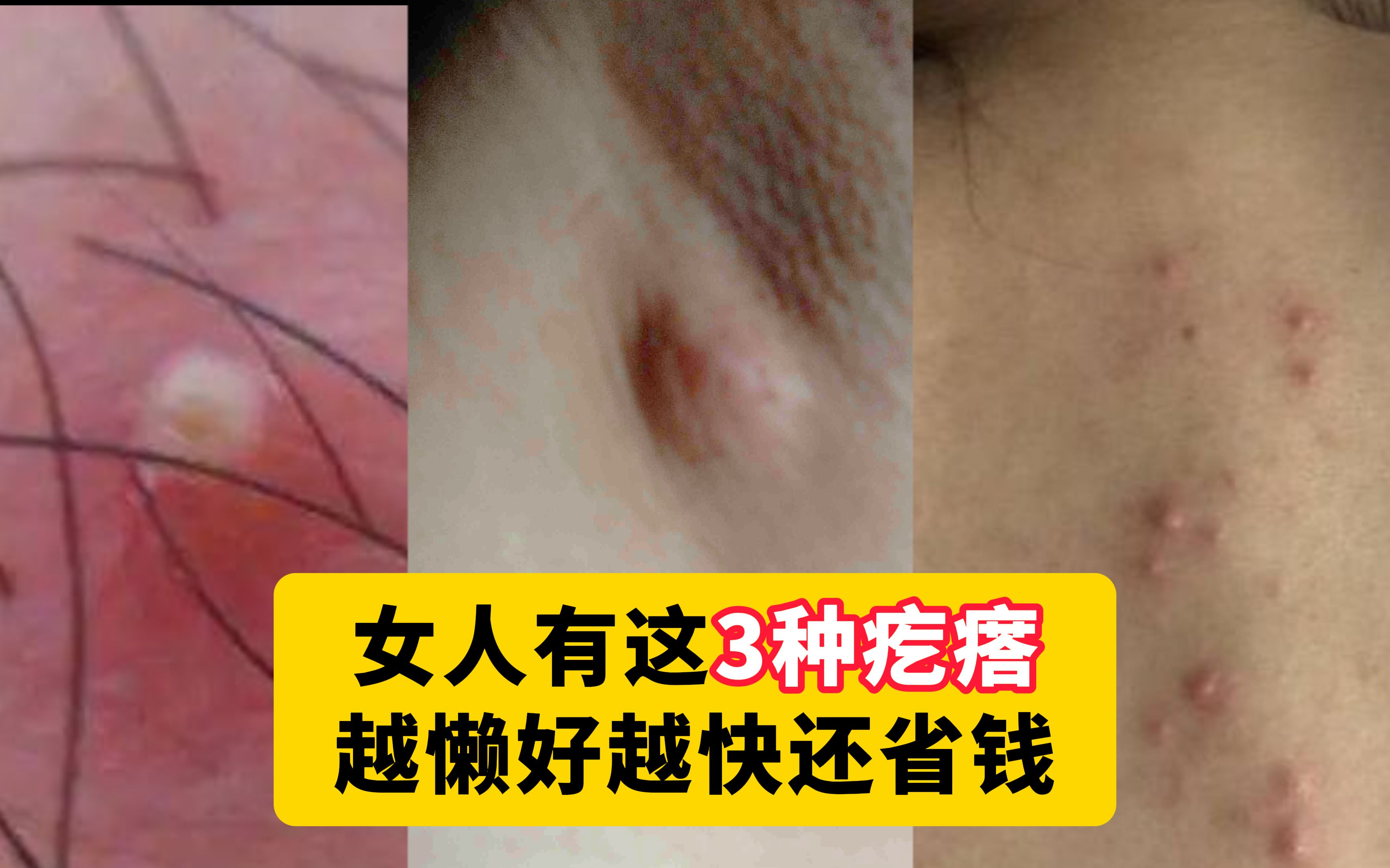 【科普】这3种疙瘩,越懒得去挤,好得越快,尤其是跟着董妈这样无痛处理!哔哩哔哩bilibili