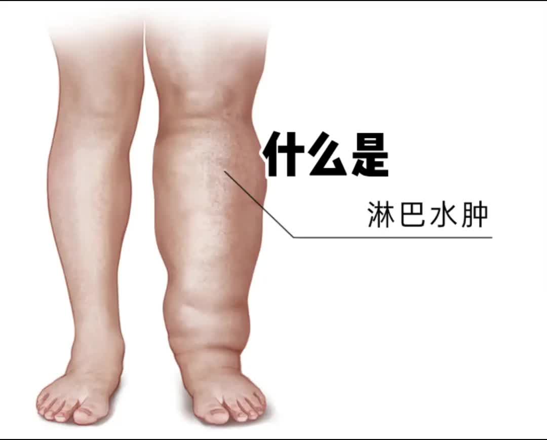 什么是淋巴水肿