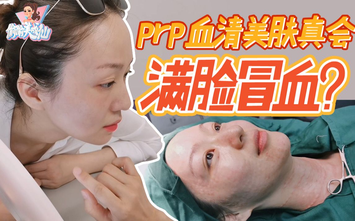 【林呵呵】PRP血清美肤体验,皱纹松弛黑眼圈毛孔粗大统统消失!效果真的还不错哦~哔哩哔哩bilibili