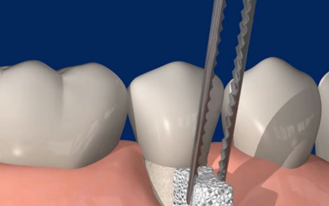 牙根外露敏感,要怎么办