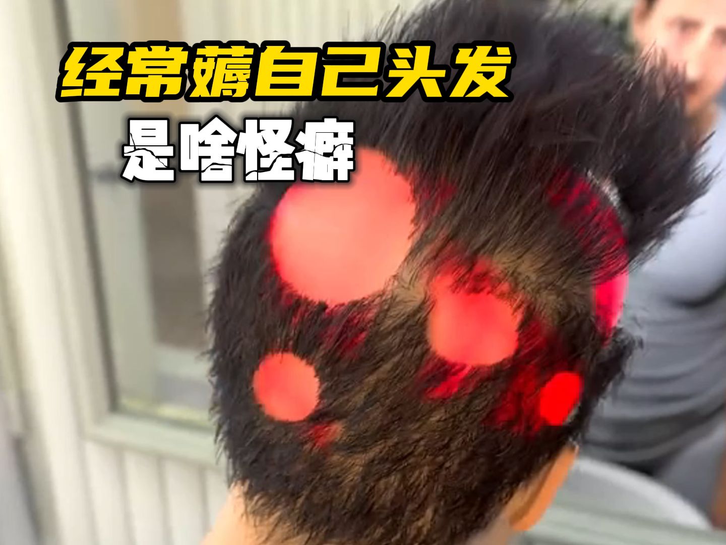 长时间乐此不疲地薅头发,会发生什么?