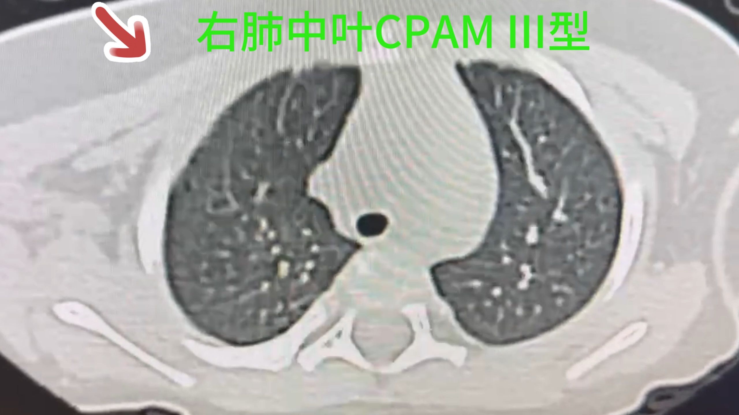 右肺中叶肺囊腺瘤切除术哔哩哔哩bilibili