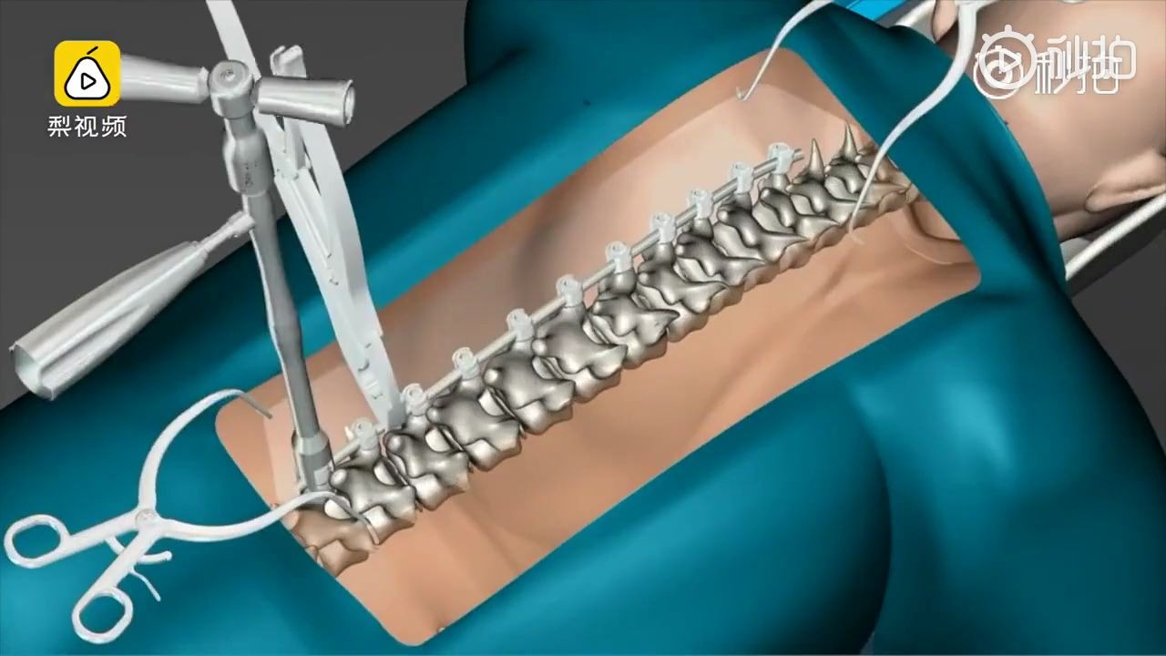 动画演示脊柱侧弯手术全过程