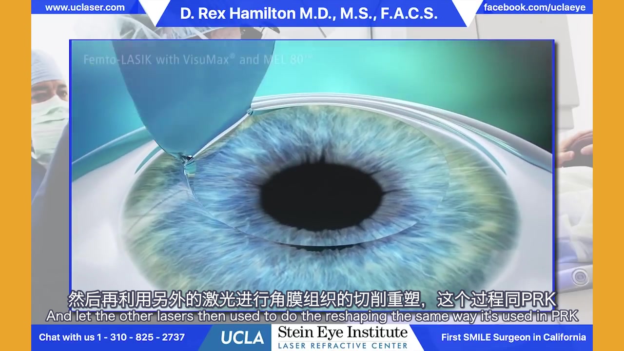 更详细的激光屈光手术讲解来了~~~来自UCLA的眼科大主任为您讲解PRK&LASIK&SMILE的主要区别哔哩哔哩bilibili