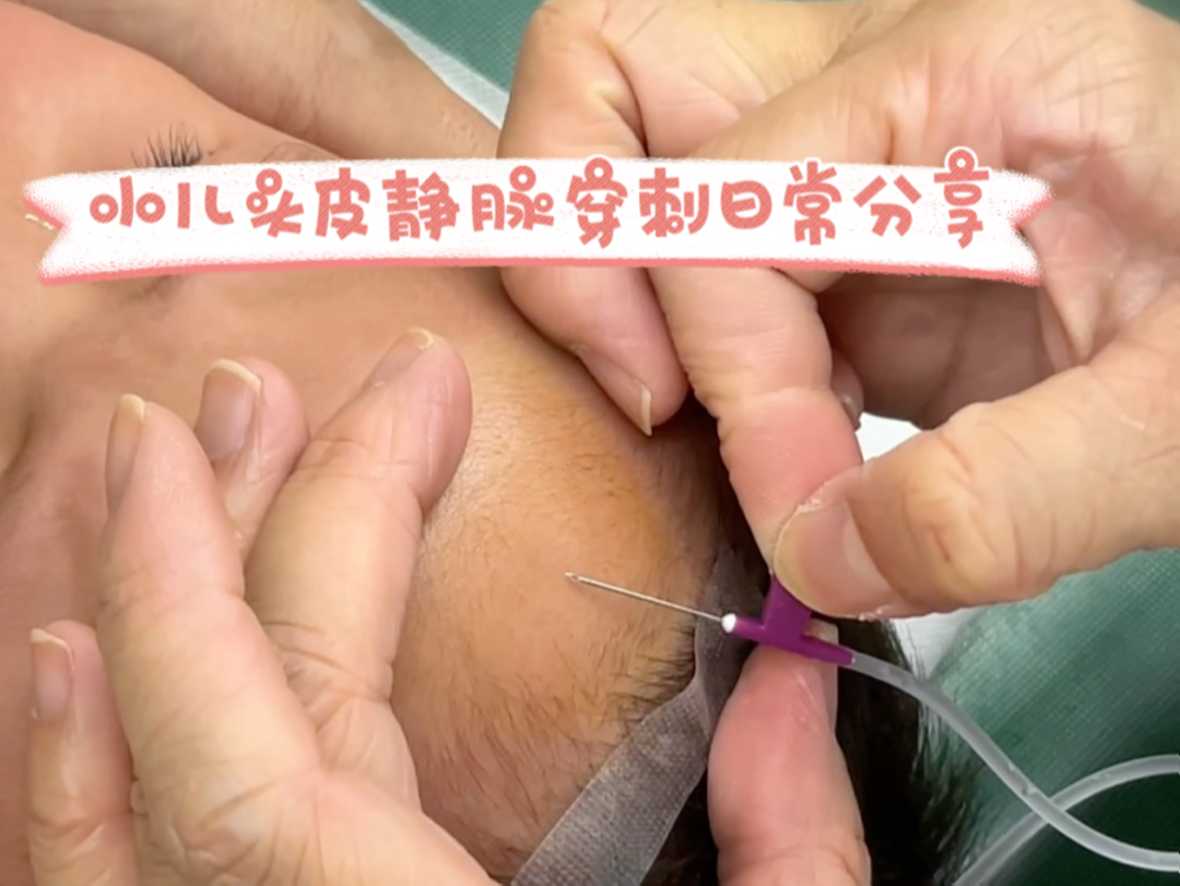 小儿头皮静脉穿刺日常分享
