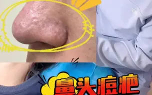 Video herunterladen: 山西来的鼻头痘疤 增生 增厚 酒糟鼻