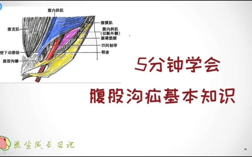 [图]5分钟学会腹股沟疝基本知识