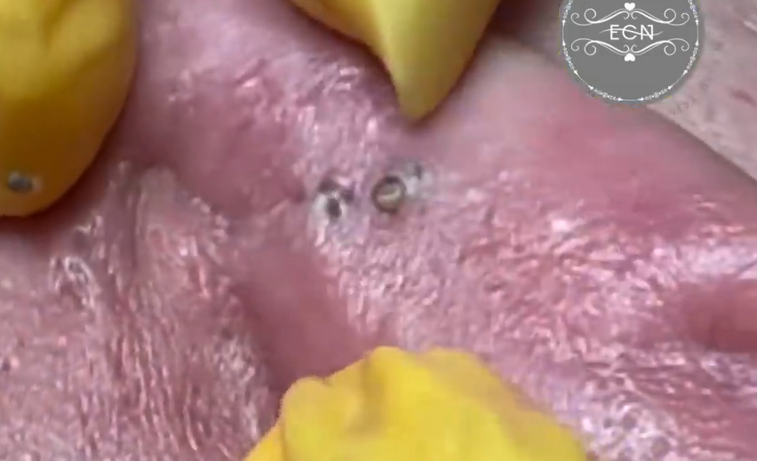 挤耳朵后面的大黑头