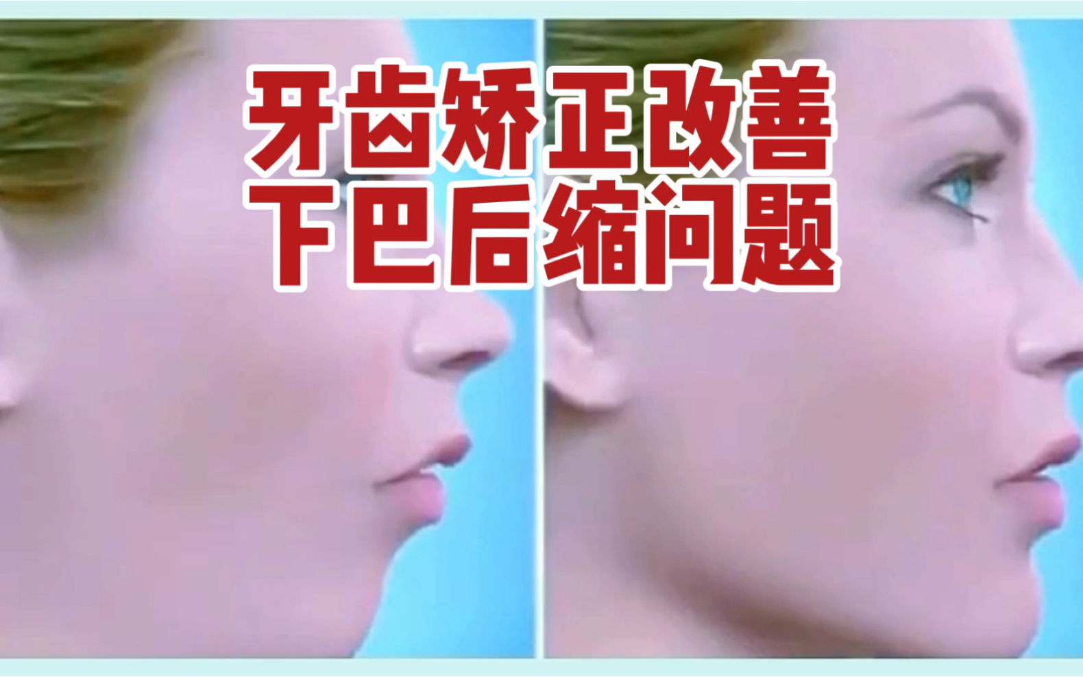 活动作品牙齿矫正改善下巴后缩问题