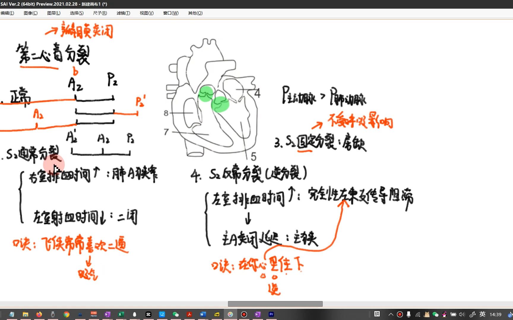 第二心音通常分裂和逆分裂哔哩哔哩bilibili